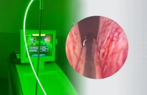 Cirurgia Laser - Dr. Marco Lipay Urologia
